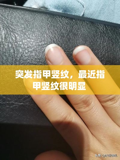 突发指甲竖纹,最近指甲竖纹很明显